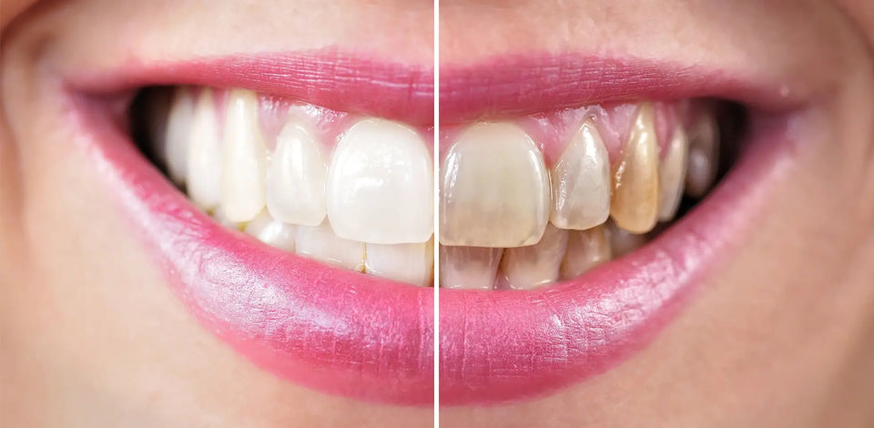 Cosmetic Dentist in Gardena, CA - Veneers, Cosmetic Crowns, and Teeth Whitening