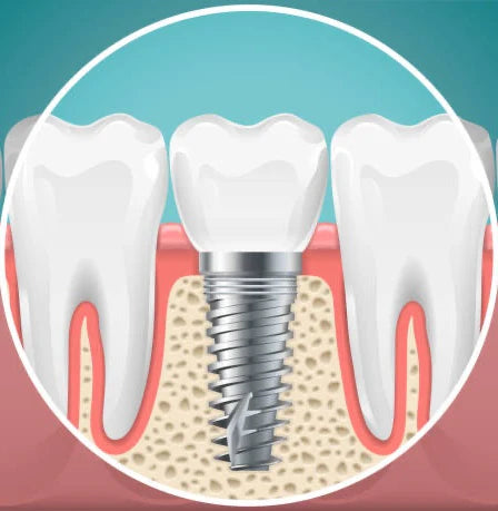Dental Implants in Gardena, CA - Permanent tooth replacement solutions